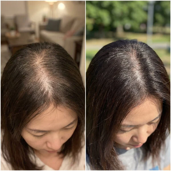 Side-by-side comparison of a woman’s scalp showing thinning hair on the left and visibly fuller, thicker hair on the right.